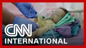 How children are bearing the brunt of famine in Yemen