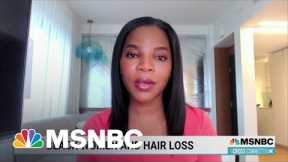 Oscars Incident Sheds New Light on Alopecia